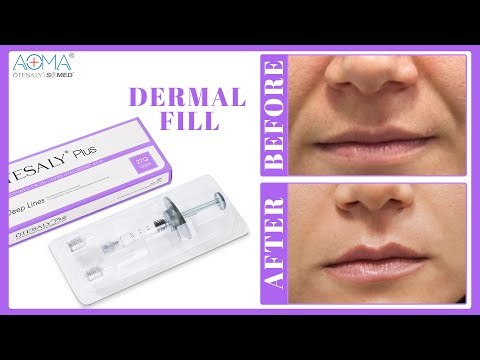 COSMETIC CLINIC OTESALY PLUS  2ML DEEP LINES HYDRATION FILLER NOSE BRIGDE