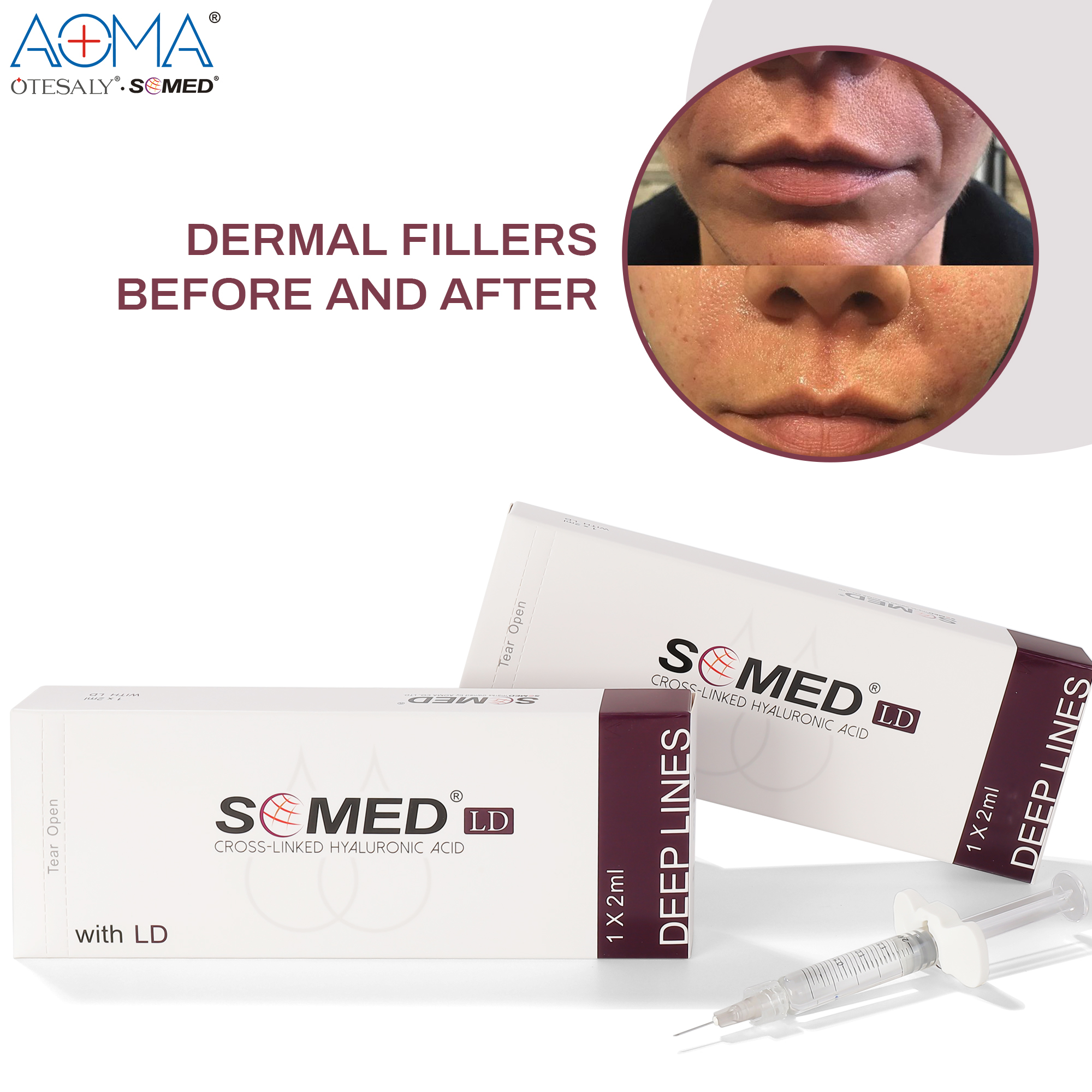 NON ANIMAL SOMED DEEP LINES 2ML LIDO ANTI WRINKLES INJECTION CHEEK DEPRESSION
