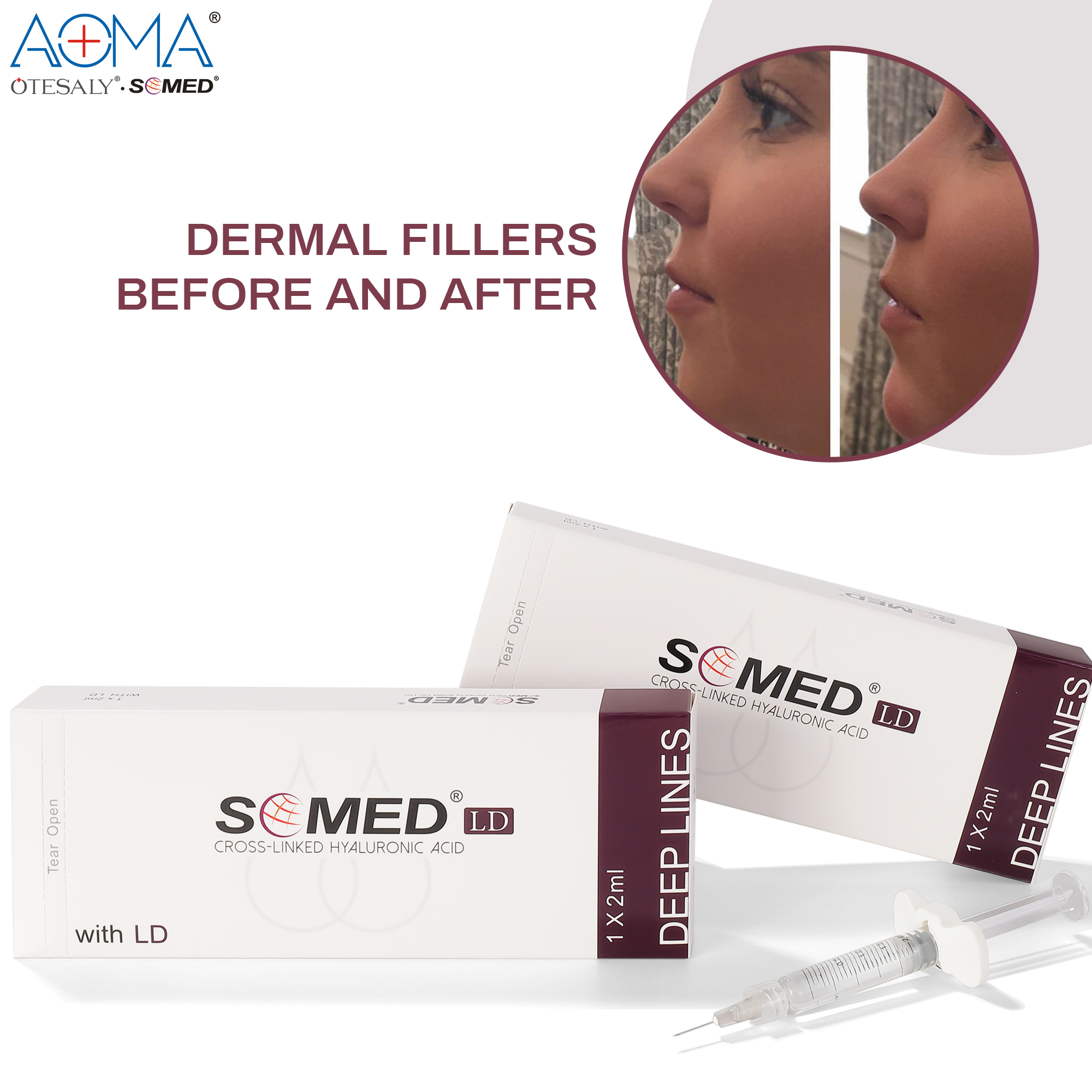 NON ANIMAL SOMED DEEP LINES 2ML LIDO ANTI WRINKLES INJECTION CHEEK DEPRESSION