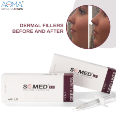 NON ANIMAL SOMED DEEP LINES 2ML LIDO ANTI WRINKLES INJECTION CHEEK DEPRESSION