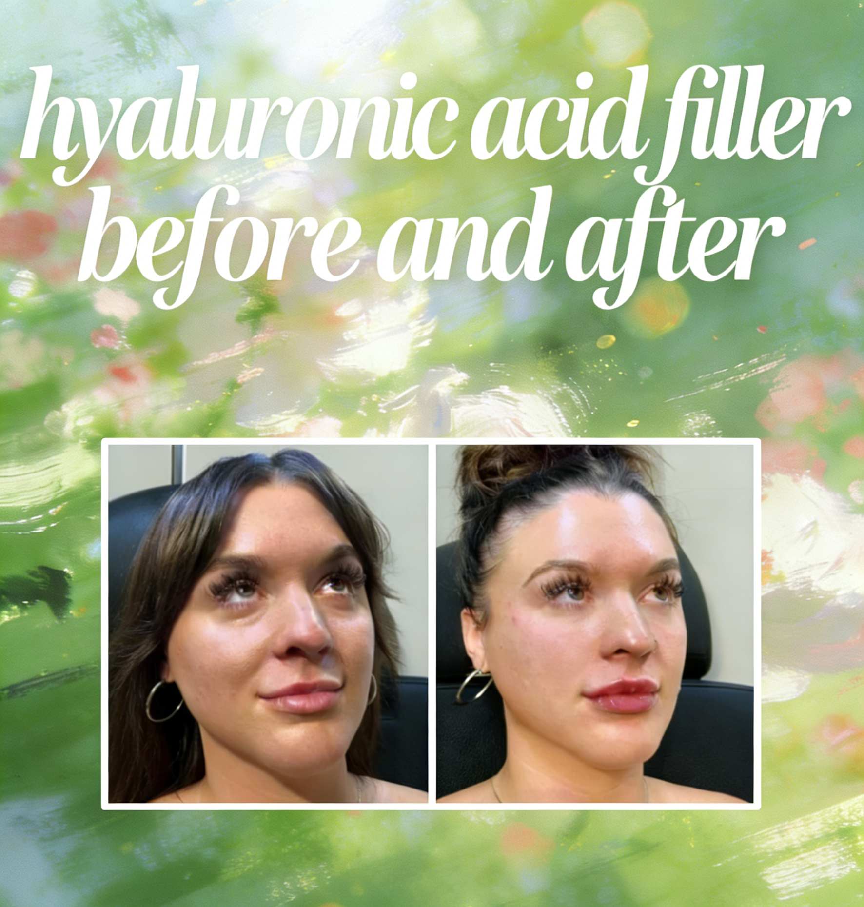 hyaluronic acid filler before and after