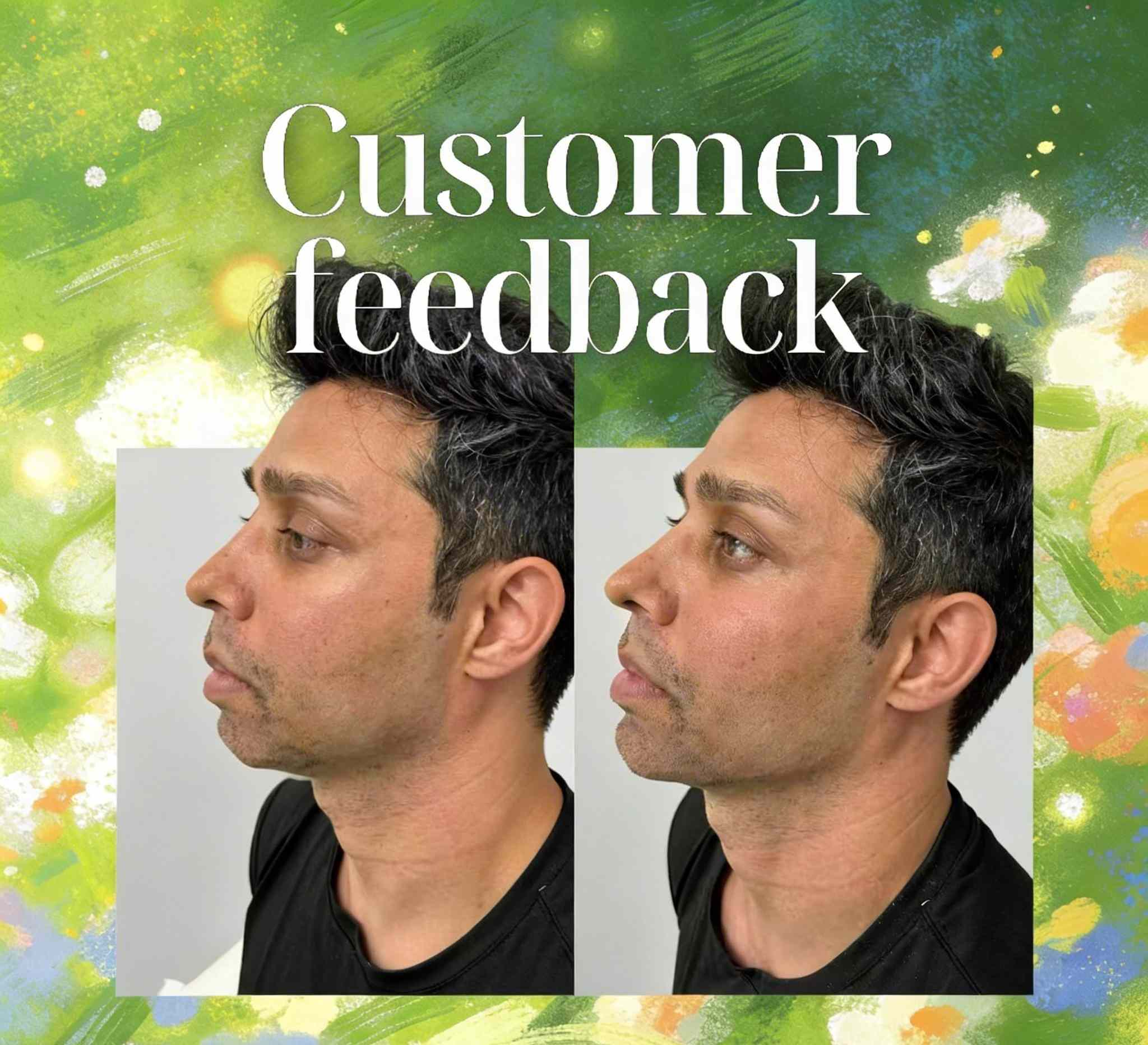 hyaluronic acid filler before and after