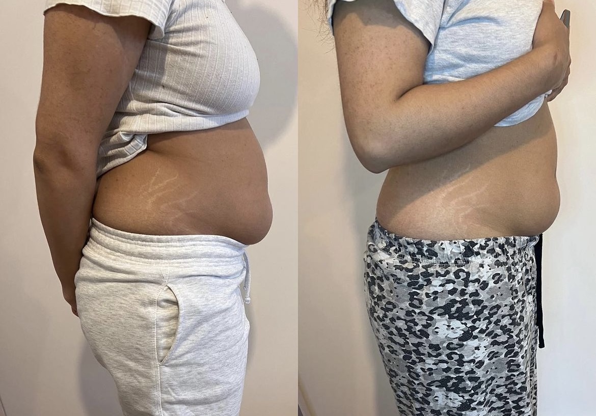 fat dissolving injections before and after
