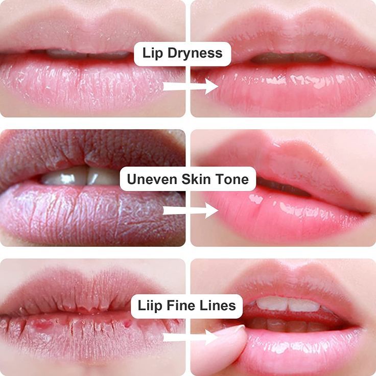 Collagen Hydrogel Lip Patch