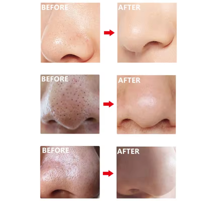 Bamboo Charcoal Blackhead Removal nose strips