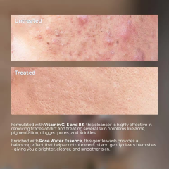 Acne and spot removal facial cleanser