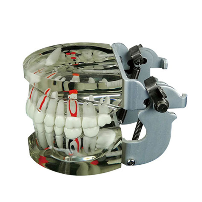 Transparent Dental Pathology Model – 28 Teeth with Implant, Caries, and Inflammation Demonstrations