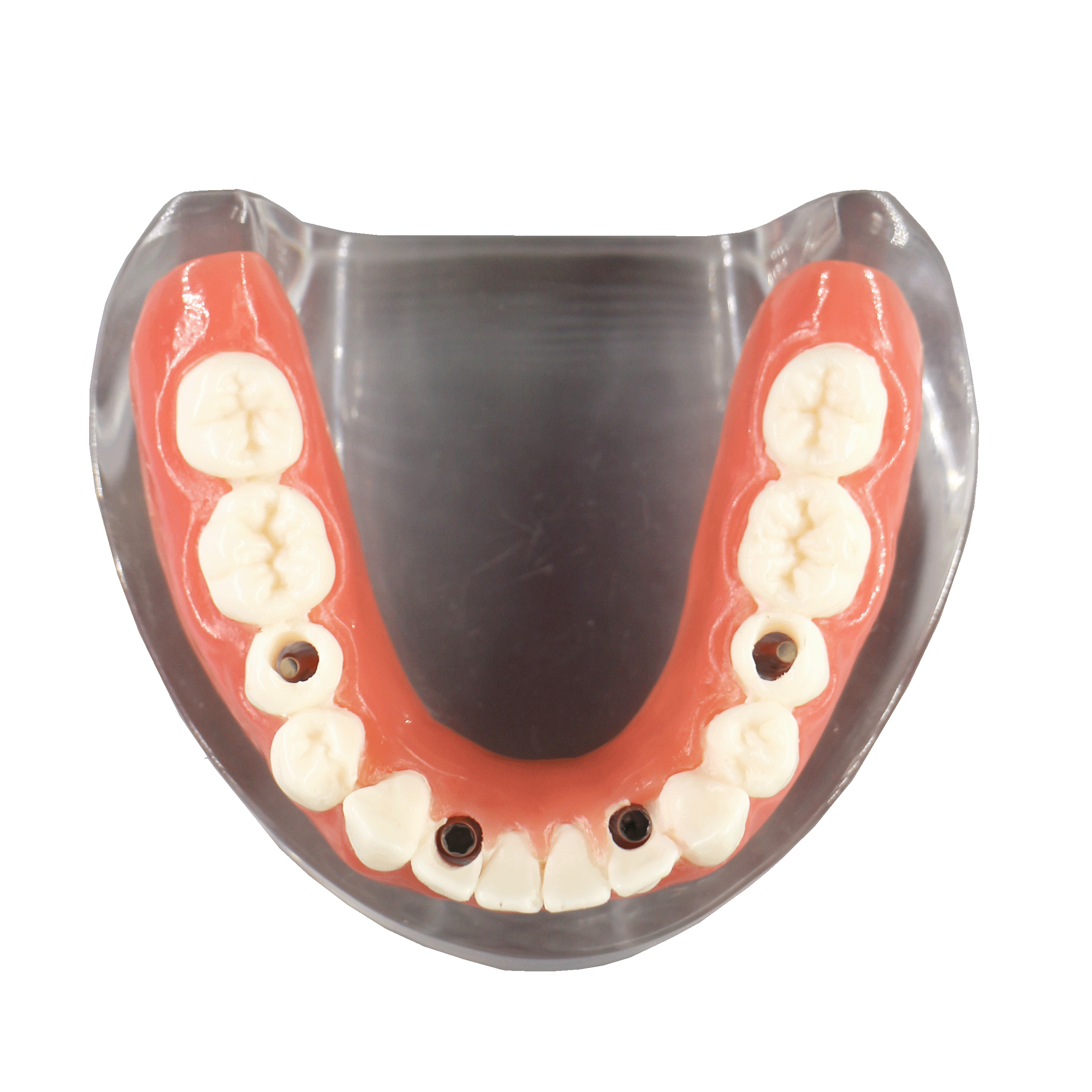 dental-implant-model-overdenture-restoration-4-lower-implants
