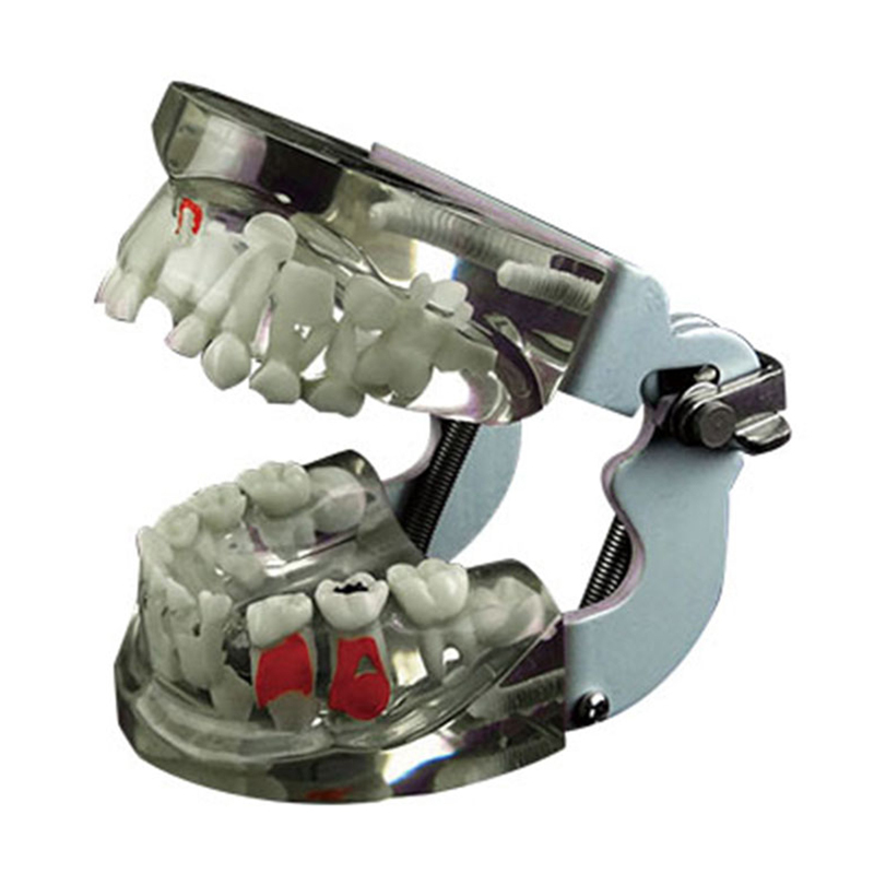 Transparent Disease Teeth Model For Paediatric Pathology