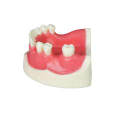 Implant Modei