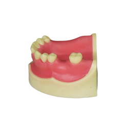 Implant Model