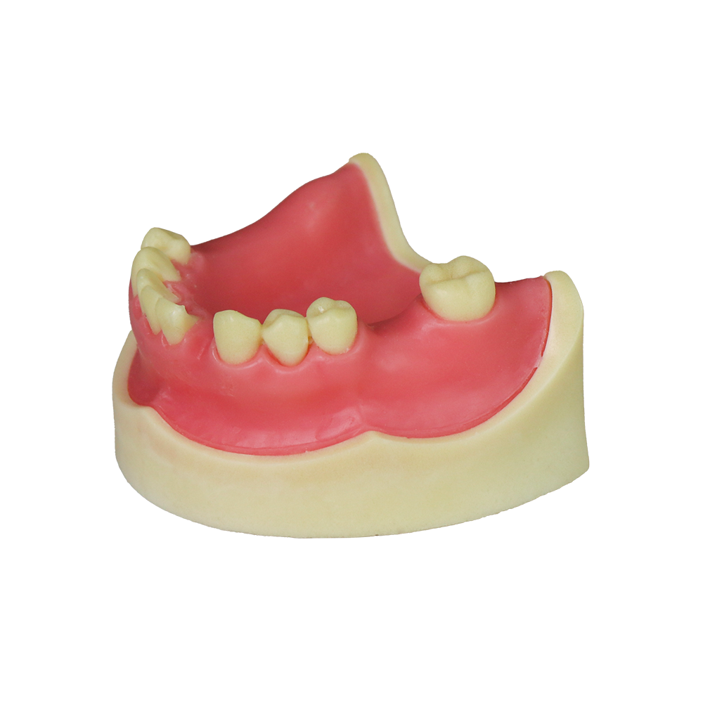 Implant Model