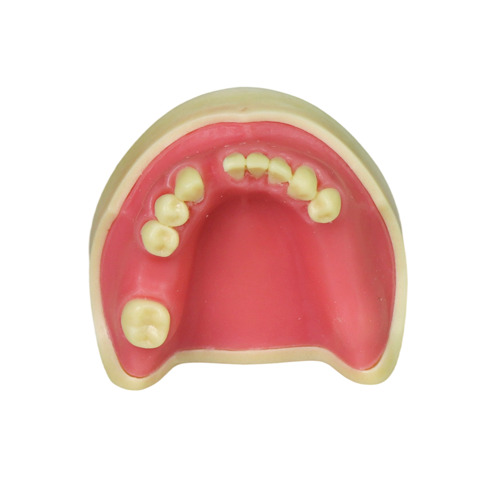 Implant Model