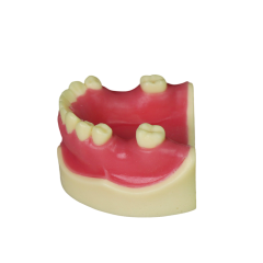 Implant Modei