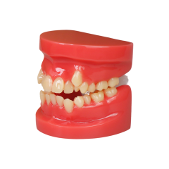 Orthodontic Demonstration Model | Malocclusion Dental Model for Patient Communication