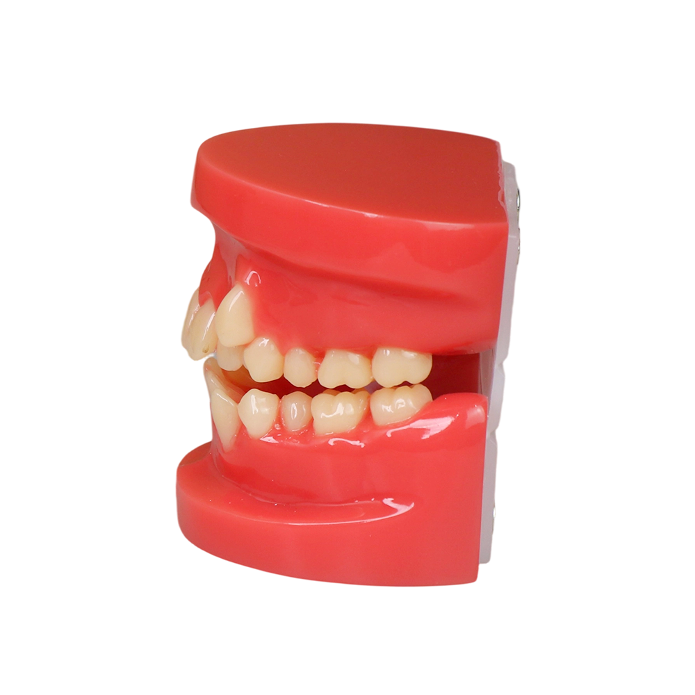 Orthodontic Demonstration Model | Malocclusion Dental Model for Patient Communication