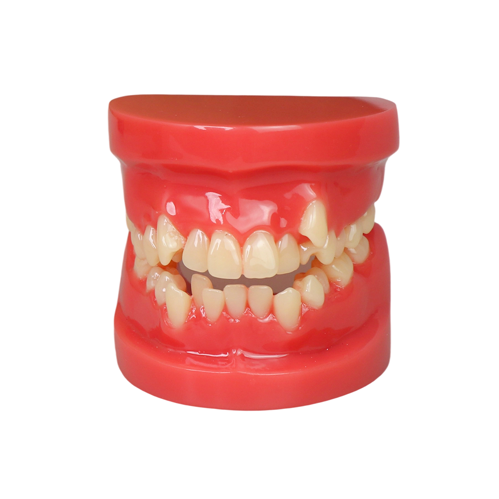 Orthodontic Demonstration Model | Malocclusion Dental Model for Patient Communication