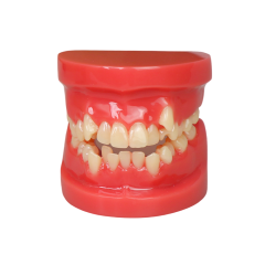 Orthodontic Demonstration Model | Malocclusion Dental Model for Patient Communication