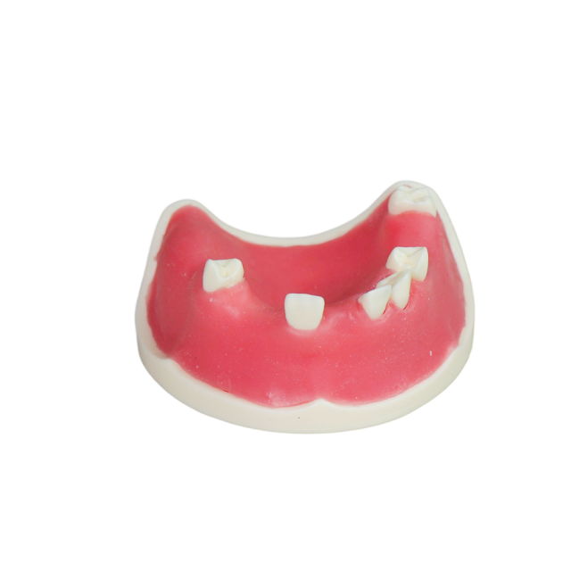 Implant Model