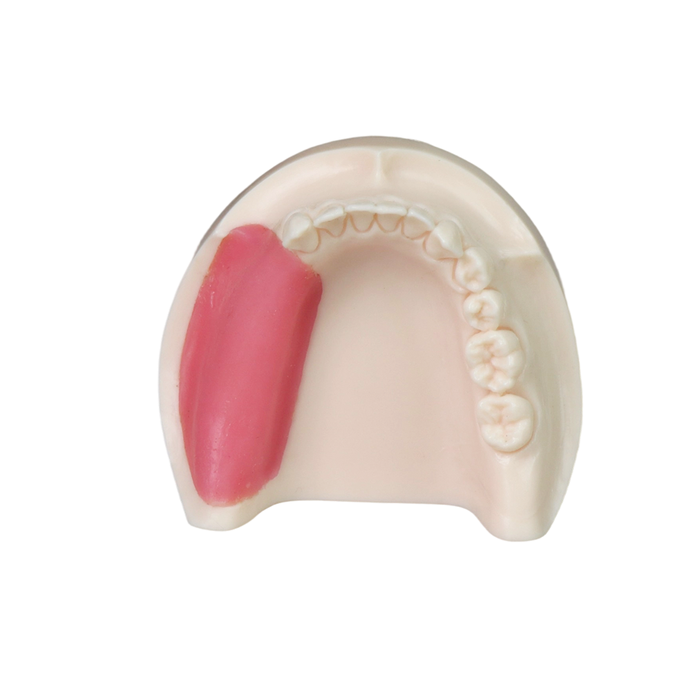 Implant Model