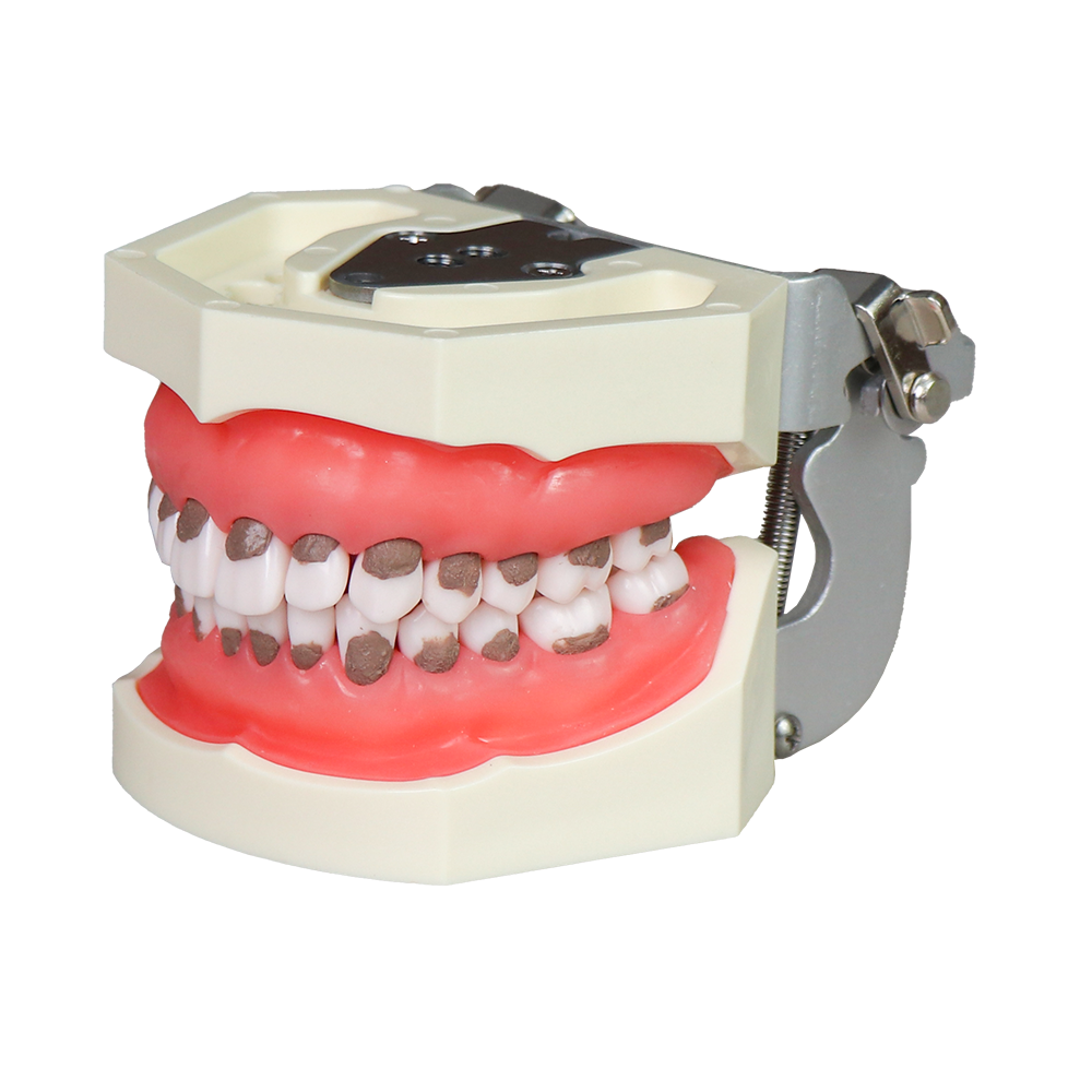 Asian Soft Gum Dental Calculus Model with FE Articulator – Removable Teeth for Scaling Practice