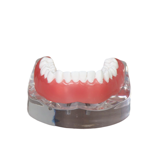 Transparent Resin Dental Implant Demonstration Model – Lower Jaw with 4 Removable Implants