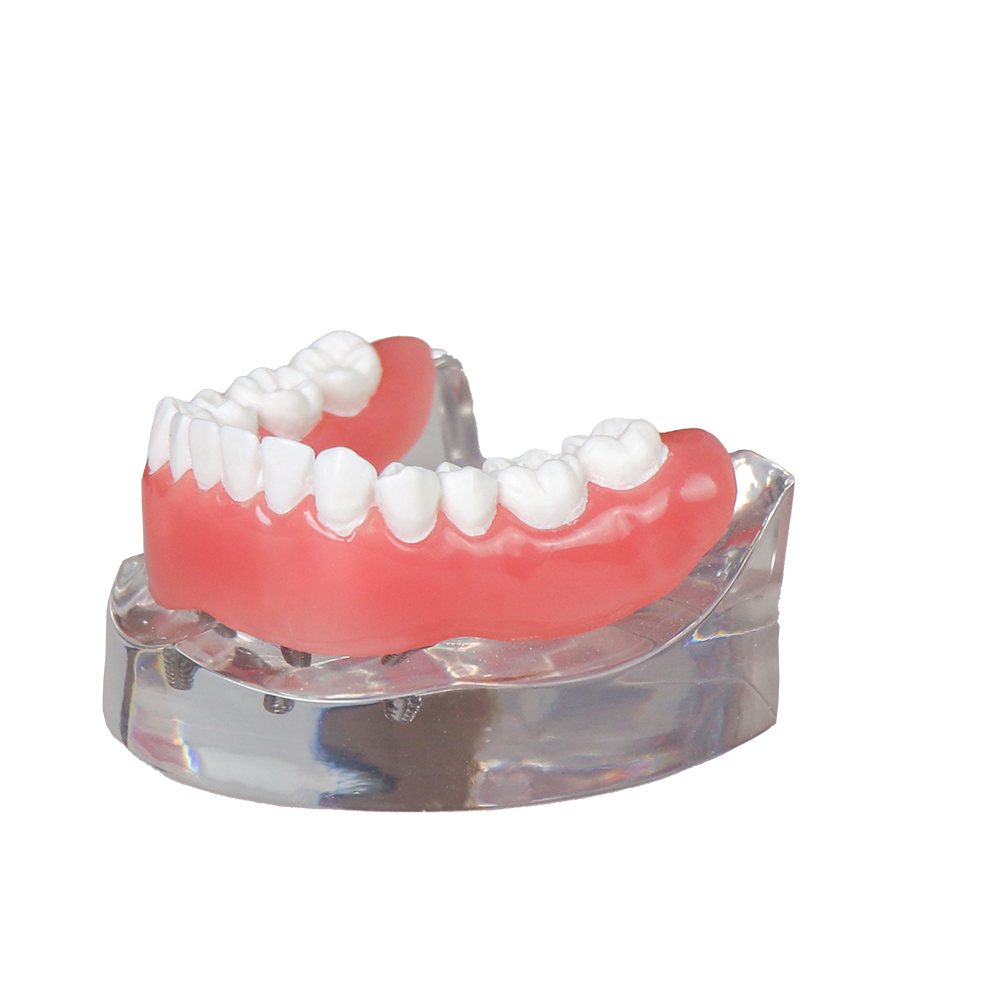 Transparent Resin Dental Implant Demonstration Model – Lower Jaw with 4 Removable Implants