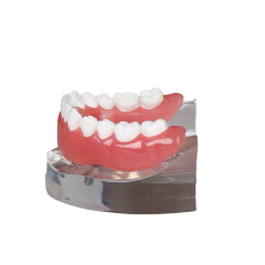 Transparent Resin Dental Implant Demonstration Model – Lower Jaw with 4 Removable Implants