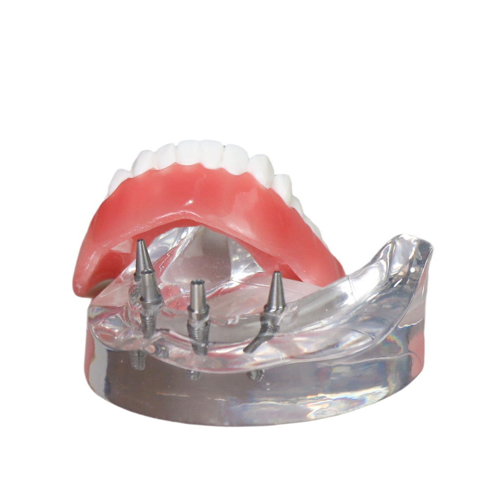 Transparent Resin Dental Implant Demonstration Model – Lower Jaw with 4 Removable Implants