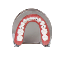 Transparent Resin Dental Implant Demonstration Model – Lower Jaw with 4 Removable Implants