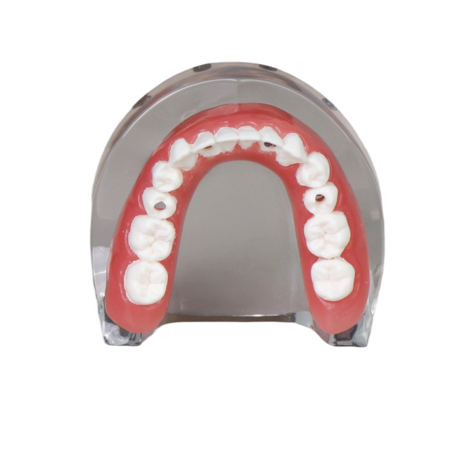 Transparent Resin Dental Implant Demonstration Model – Lower Jaw with 4 Removable Implants