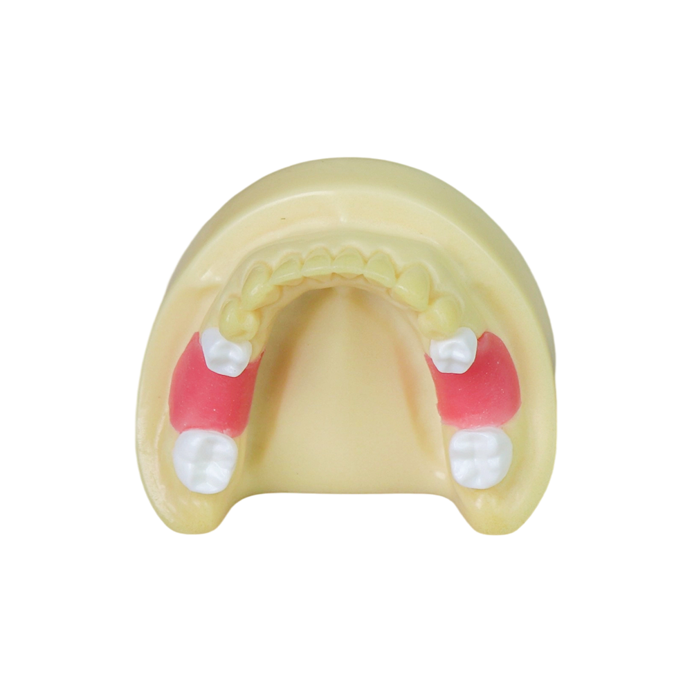 Dental Implant Model – D2 Soft Resin with Gums for Implant Training JG-Y8-F1-3