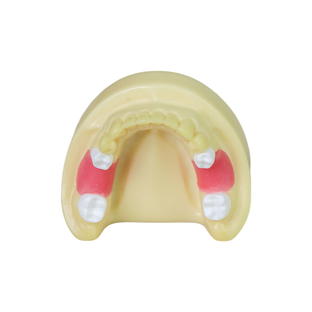 Dental Implant Model – D2 Soft Resin with Gums for Implant Training JG-Y8-F1-3