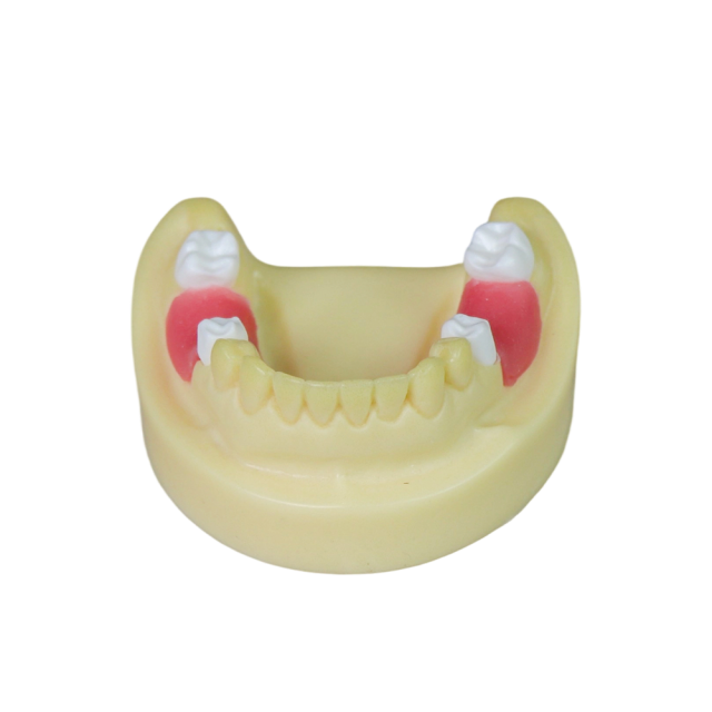 Dental Implant Model – D2 Soft Resin with Gums for Implant Training JG-Y8-F1-3