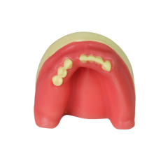 Dental Implant Model – D2 Soft Resin with Gums for Implant Training JG-Y8-F4