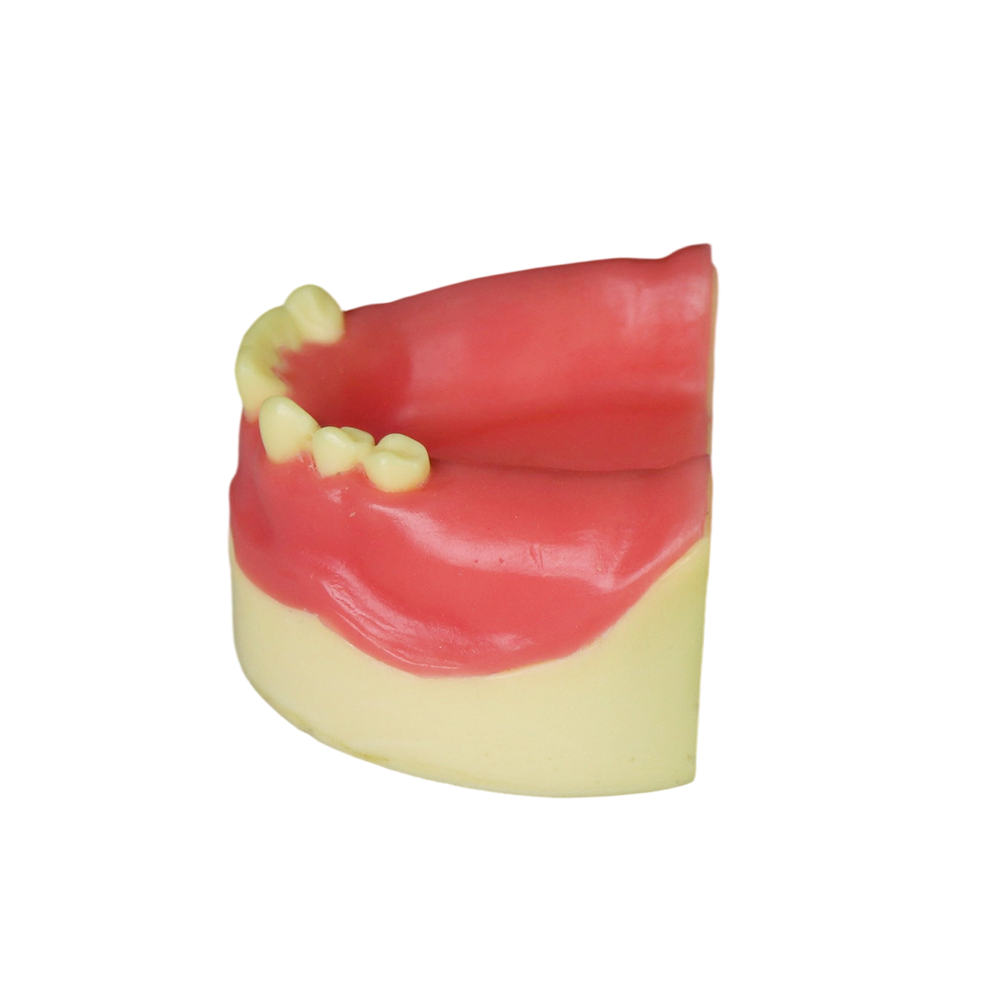 Dental Implant Model – D2 Soft Resin with Gums for Implant Training JG-Y8-F4