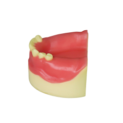 Dental Implant Model – D2 Soft Resin with Gums for Implant Training JG-Y8-F4