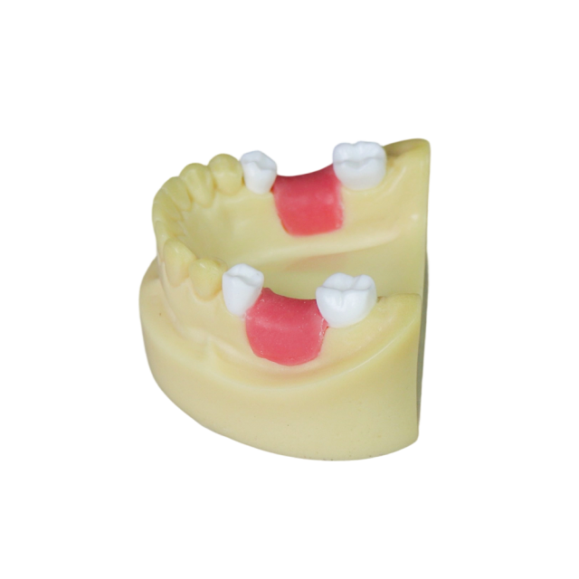 Dental Implant Model – D2 Soft Resin with Gums for Implant Training JG-Y8-F1-3