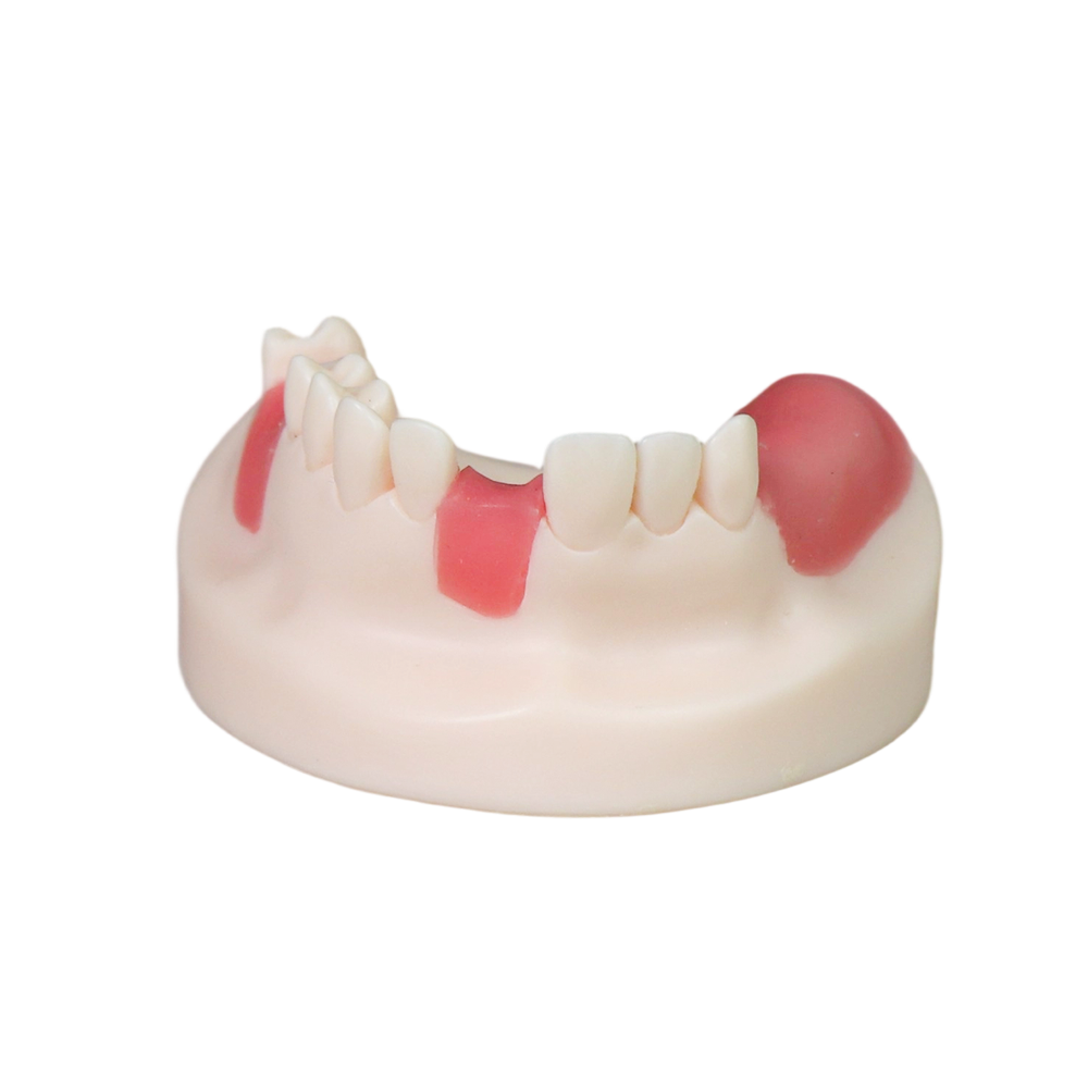 Dental Implant Model – D1 Soft Resin with Gums for Implant Training JG-Y8-F6