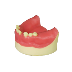 Dental Implant Model – D2 Soft Resin with Gums for Implant Training JG-Y8-F4
