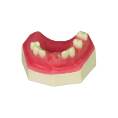 Fast Implant Dental Model – Soft Resin and Soft Gums for Implant Training JG-YZ-15