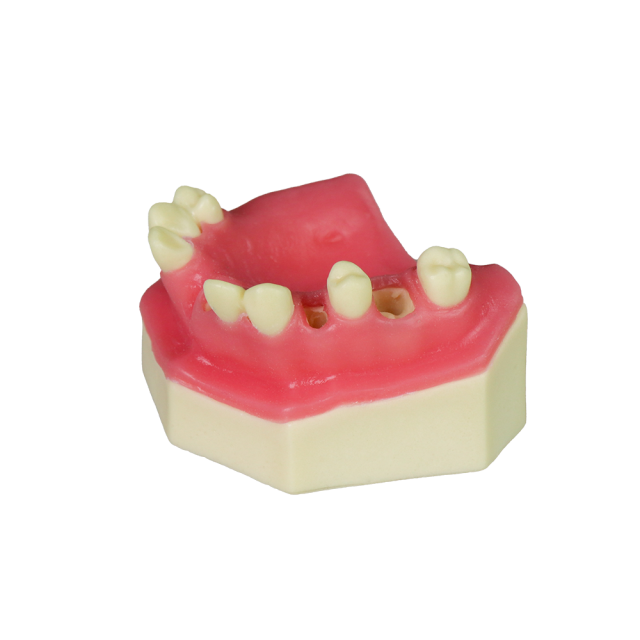 Fast Implant Dental Model – Soft Resin and Soft Gums for Implant Training JG-YZ-15