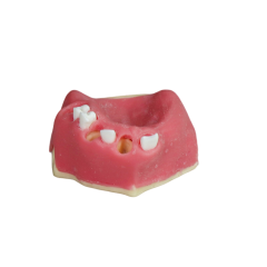 Fast Implant Dental Model – Soft Resin and Soft Gums for Implant Training JG-Y26-2