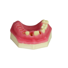 Fast Implant Dental Model – Soft Resin and Soft Gums for Implant Training JG-Y8-F3