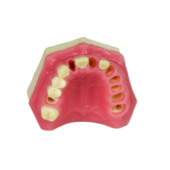 Fast Implant Dental Model – Soft Resin and Soft Gums for Implant Training JG-Y8-F3
