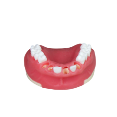 Dental Implant Training Model – Hard Resin with Soft Gum for Implant Practice JG-Y8-F2