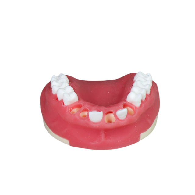 Dental Implant Training Model – Hard Resin with Soft Gum for Implant Practice JG-Y8-F2