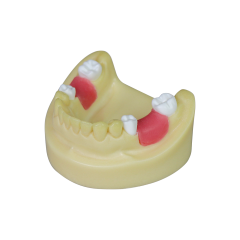 Dental Implant Model – D2 Soft Resin with Gums for Implant Training JG-Y8-F1-3
