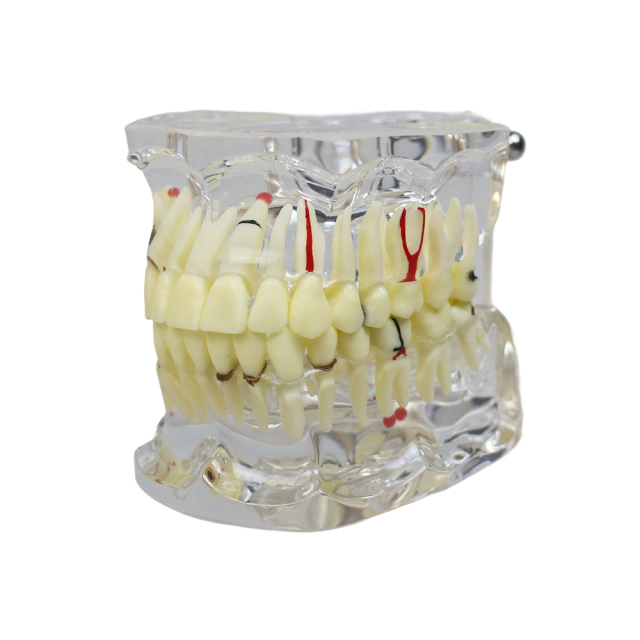 Transparent Standard Dental Pathology Model – Implants, Caries & Root Inflammation