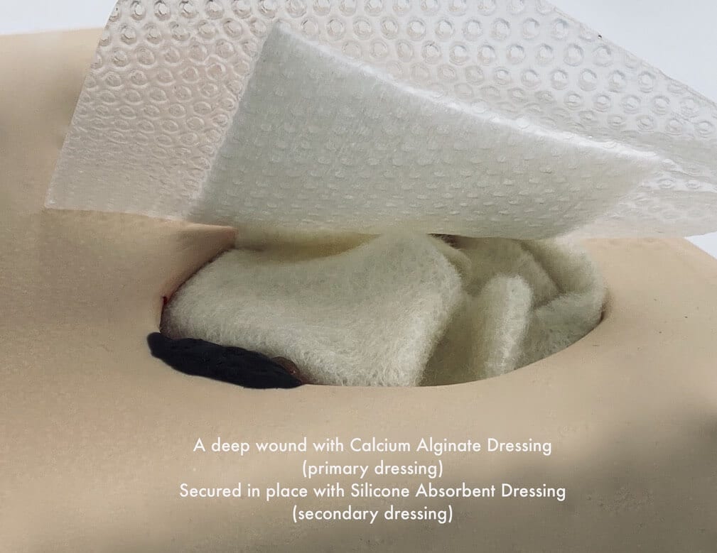 What is Alginate Dressing in Roll Form and How to Use It?